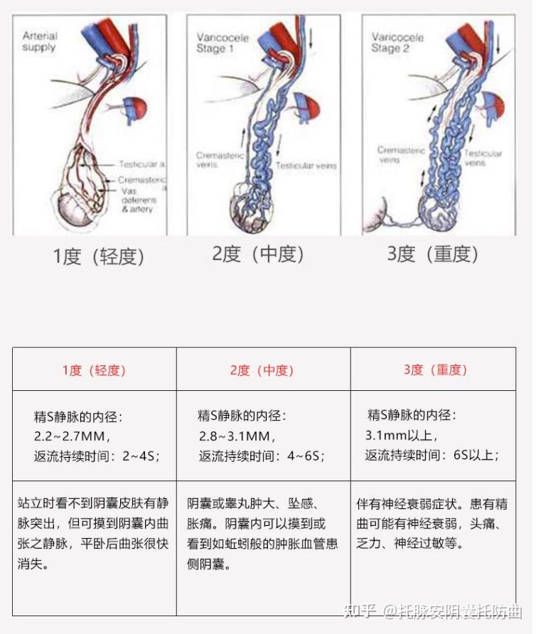 精索靜脈曲張三個(gè)程度圖詳解，精索靜脈曲張三個(gè)程度詳解圖解