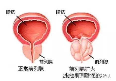 前列腺肥大最佳治療效果探討，前列腺肥大最佳治療方案的探討與研究