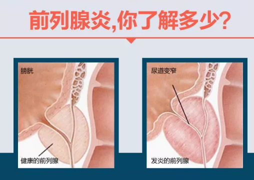 前列腺炎的治愈可能性，理解與探索，前列腺炎的治愈可能性，深入理解與探索