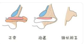 包莖手術(shù)費(fèi)用