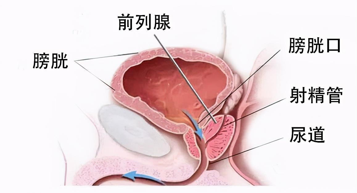 前列腺炎治療周期詳解，前列腺炎治療周期全面解析