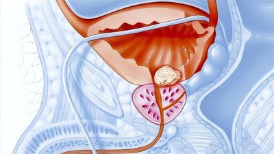 前列腺炎的治療費(fèi)用分析，前列腺炎治療費(fèi)用詳解