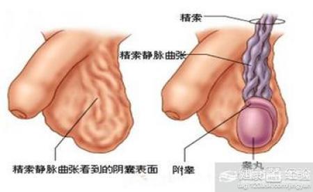 精索靜脈曲張可以自愈嗎？解析與探討，精索靜脈曲張能否自愈？解析與探討