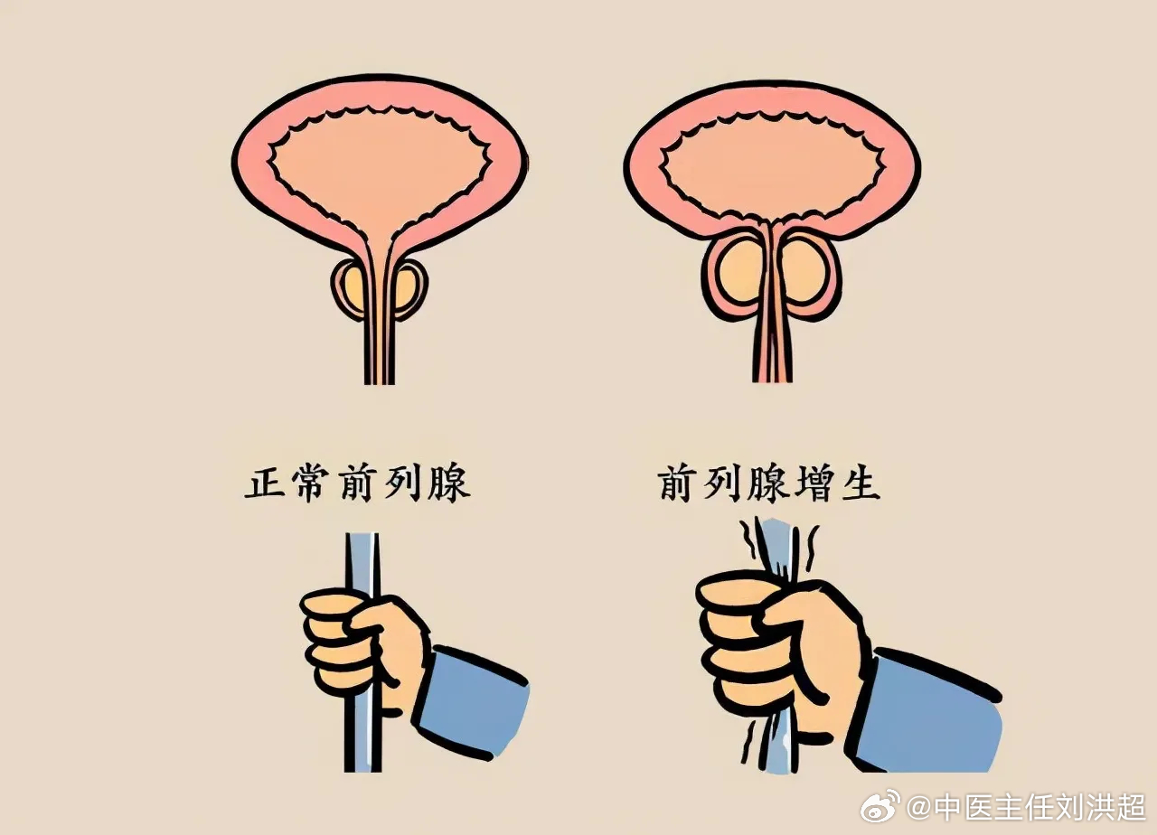 前列腺結(jié)石與性功能障礙，是否存在關(guān)聯(lián)？，前列腺結(jié)石與性功能障礙的關(guān)聯(lián)探討，是否存在潛在聯(lián)系？