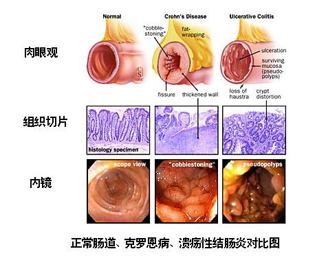 克羅恩病最常見的癥狀及其影響，克羅恩病常見癥狀及其影響概述